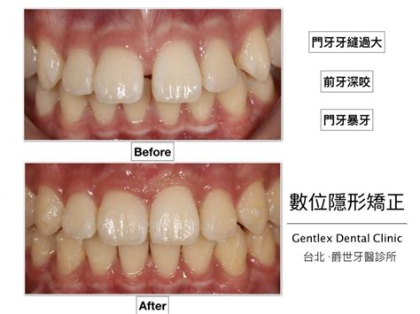 門牙過大